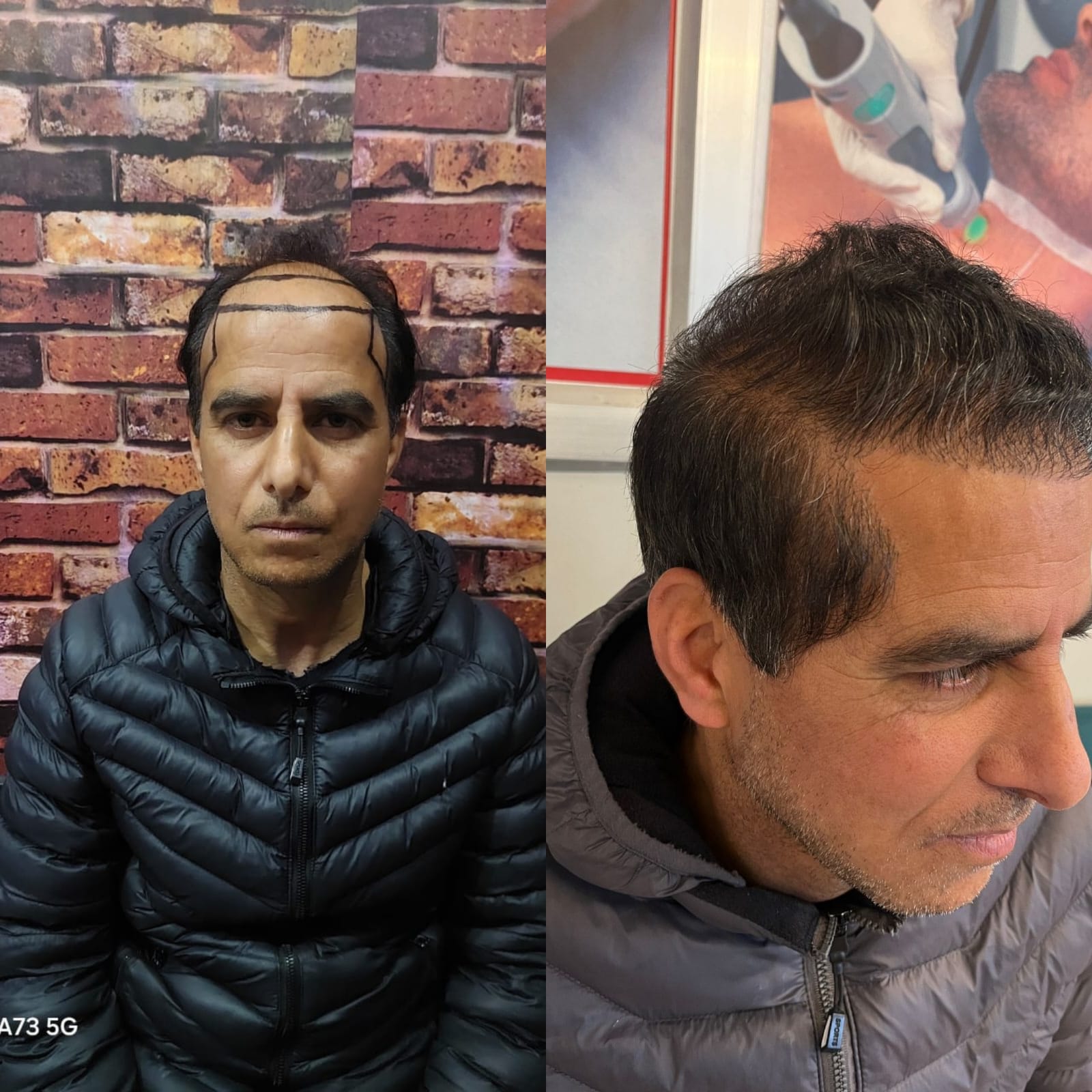 Before and after GFC/PRP hair treatment result - Case 1