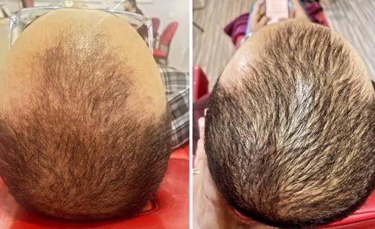 Before and after GFC/PRP hair treatment result - Case 2