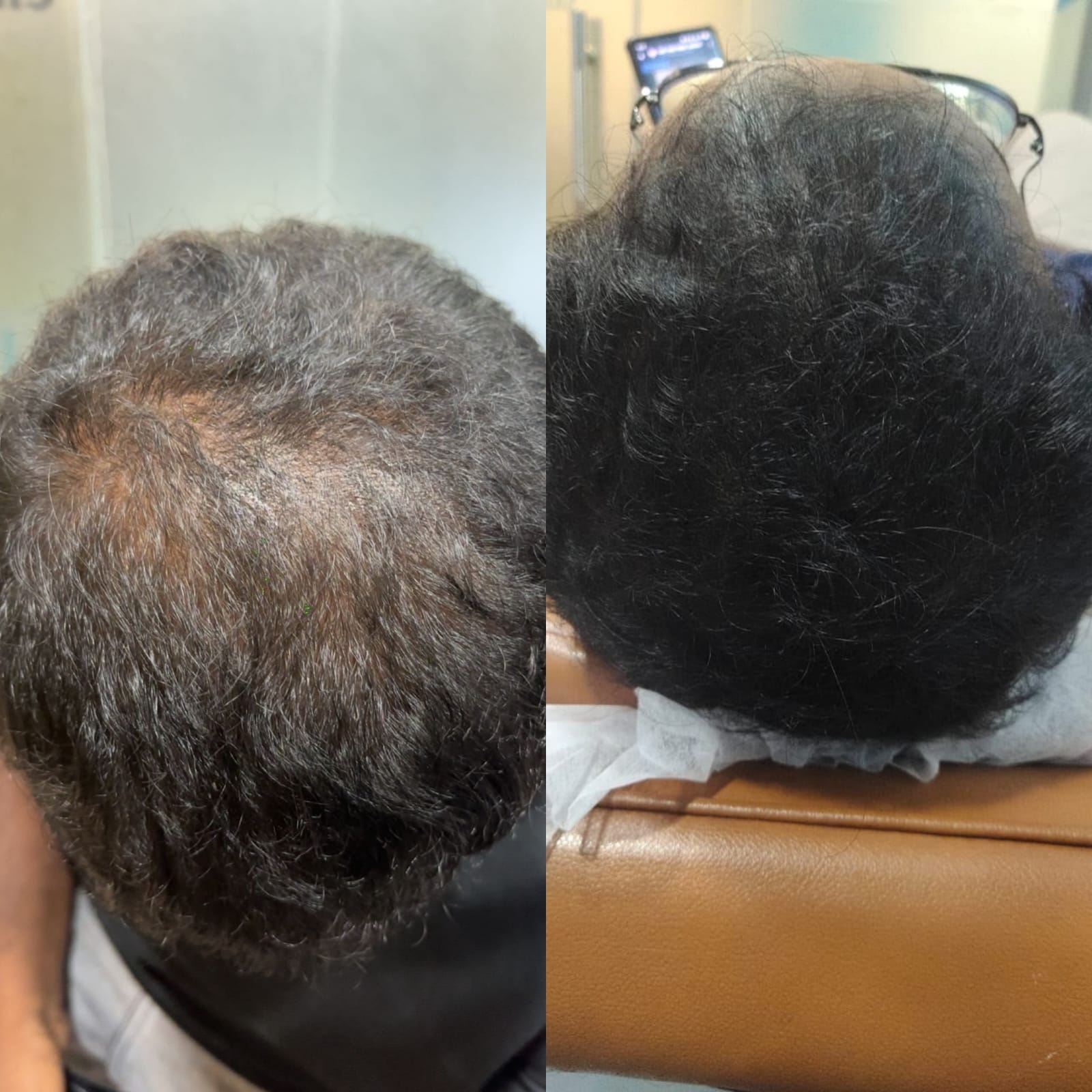 Before and after GFC/PRP hair treatment result - Case 3
